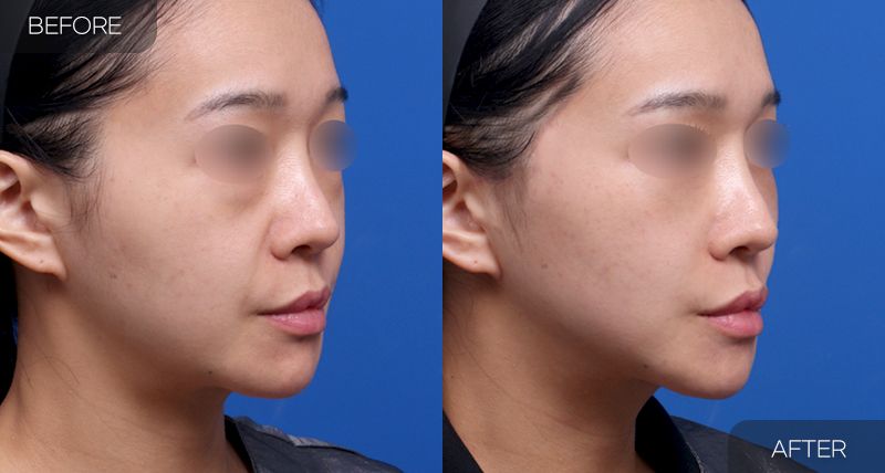 Gambar sebelum dan selepas pembedahan: Facelift Separa 1 (Sudut 45 Darjah)