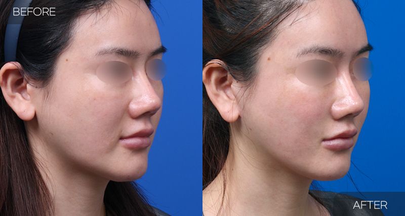 Gambar sebelum dan selepas pembedahan: Mini Facelift 1 (Sudut 45 Darjah)
