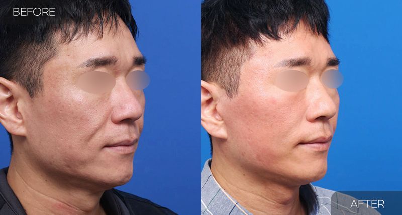 Gambar sebelum dan selepas pembedahan: Facelift Penuh 1 (Sudut 45 Darjah)