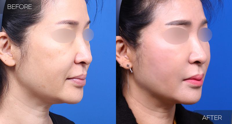 Gambar sebelum dan selepas pembedahan: Thread Lift 1 (Sudut 45 Darjah)