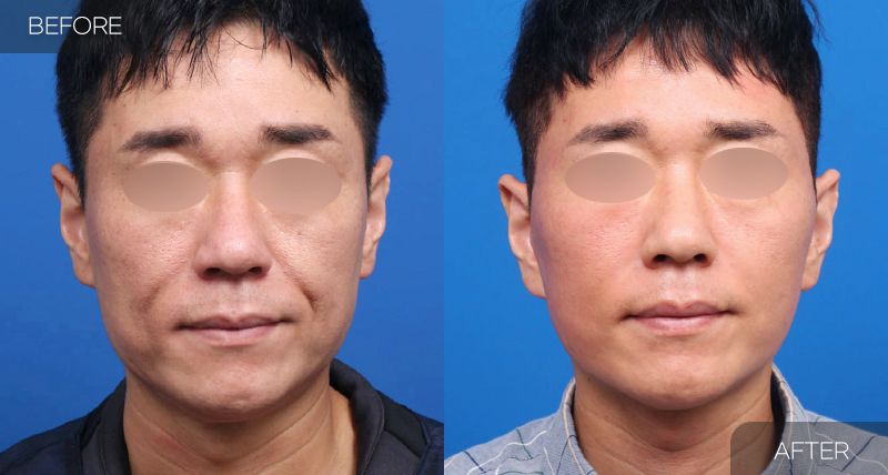 Gambar sebelum dan selepas pembedahan: Facelift Penuh 1 (Pandangan Hadapan)