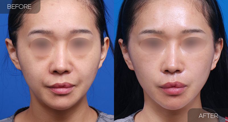 Gambar sebelum dan selepas pembedahan: Facelift Separa 1 (Pandangan Hadapan)