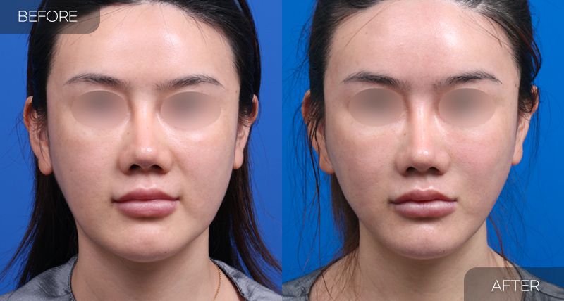 Gambar sebelum dan selepas pembedahan: Mini Facelift 1 (Pandangan Hadapan)