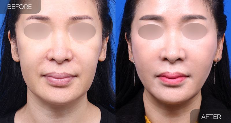Gambar sebelum dan selepas pembedahan: Thread Lift 1 (Pandangan Hadapan)