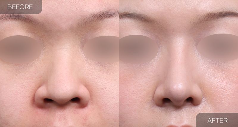 Gambar sebelum dan selepas pembedahan: Pengecilan Cuping Hidung 1