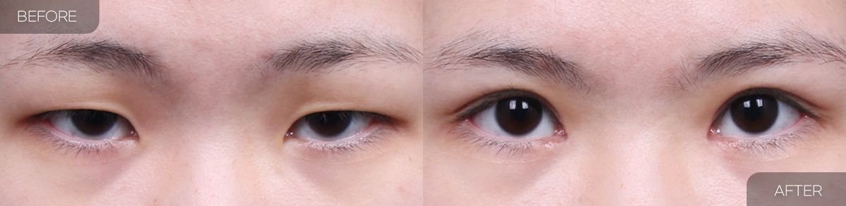 Gambar sebelum dan selepas pembedahan: Pembetulan Bentuk Mata 1