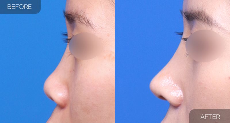 Gambar sebelum dan selepas pembedahan: Hidung Pendek 1