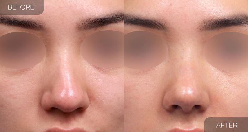 Gambar sebelum dan selepas pembedahan: Hidung Bengkok 1