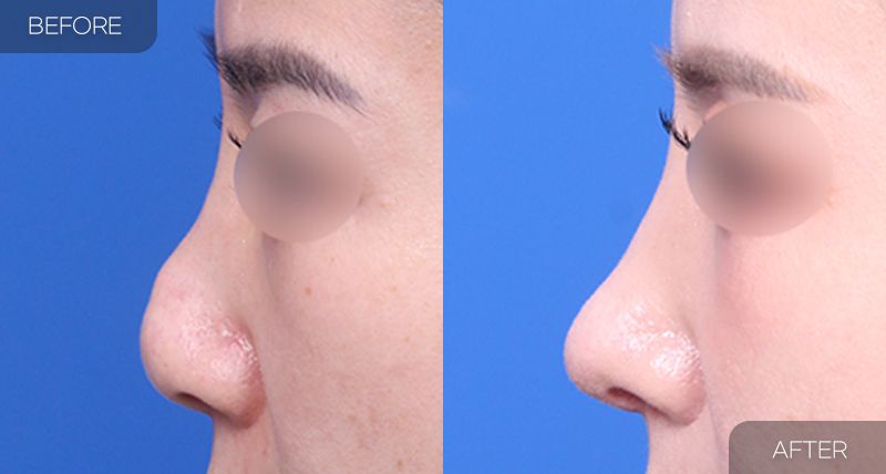 Gambar sebelum dan selepas pembedahan: Pembedahan Semula Hidung 1