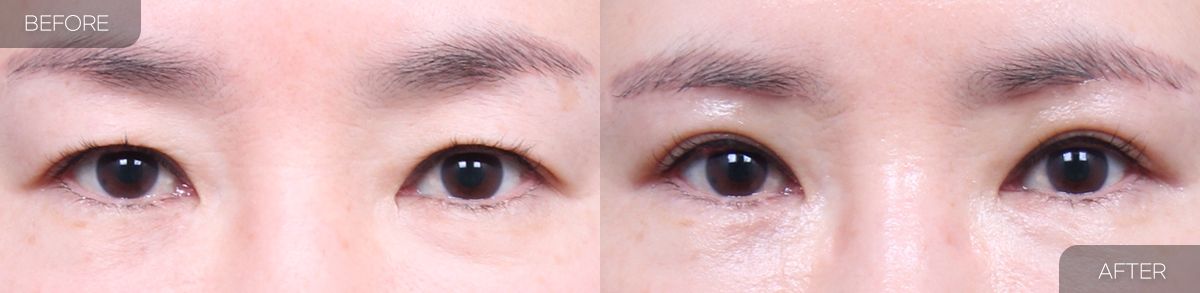 Gambar sebelum dan selepas pembedahan: Pengangkatan Kening 1