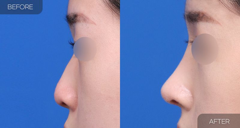 Gambar sebelum dan selepas pembedahan: Hidung Berbonggol 1