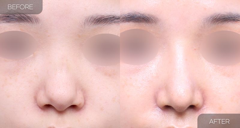 Gambar sebelum dan selepas pembedahan: Hidung Bulbus 1