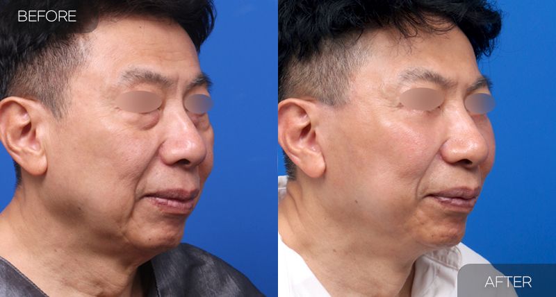 Gambar sebelum dan selepas pembedahan: Facelift Penuh 2 (Sudut 45 Darjah)