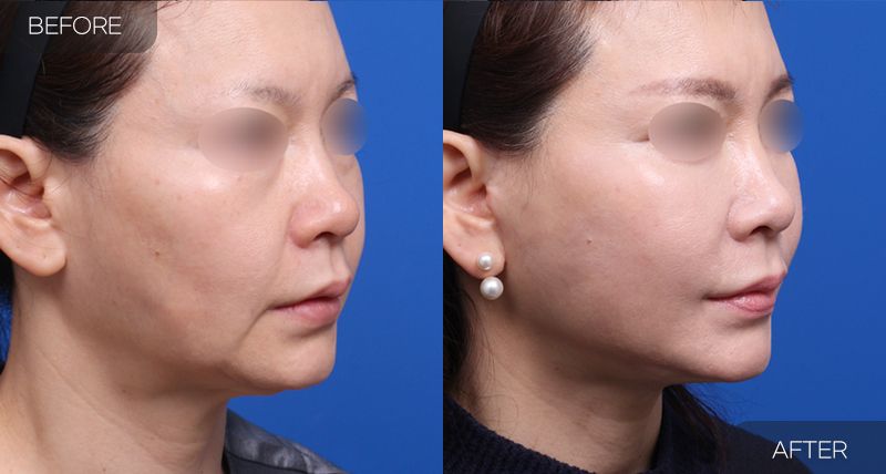 Gambar sebelum dan selepas pembedahan: Facelift Separa 2 (Sudut 45 Darjah)