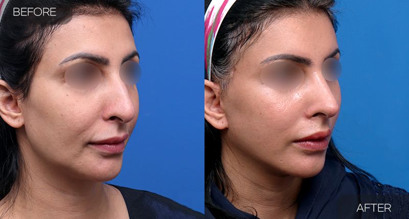 Gambar sebelum dan selepas pembedahan: Mini Facelift 2 (Sudut 45 Darjah)