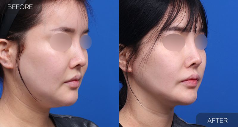 Gambar sebelum dan selepas pembedahan: Thread Lift 2 (Sudut 45 Darjah)