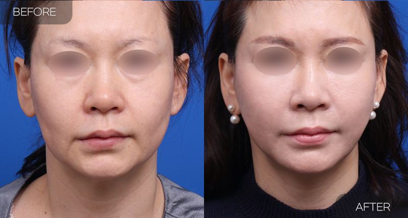 Gambar sebelum dan selepas pembedahan: Facelift Separa 2 (Pandangan Hadapan)