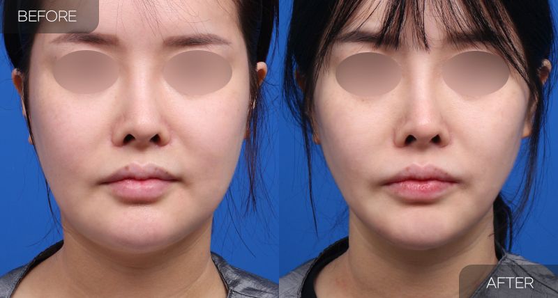 Gambar sebelum dan selepas pembedahan: Thread Lift 2 (Pandangan Hadapan)