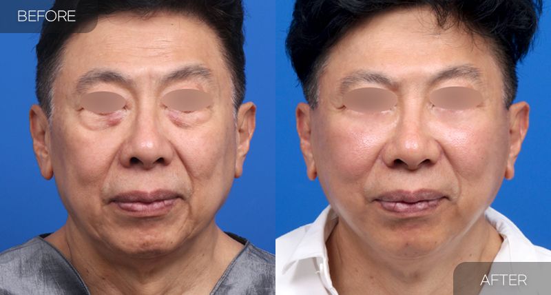 Gambar sebelum dan selepas pembedahan: Facelift Penuh 2 (Pandangan Hadapan)