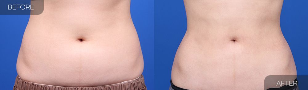 Gambar sebelum dan selepas pembedahan: Sedutan Lemak Abdomen 2 (Pandangan Hadapan)