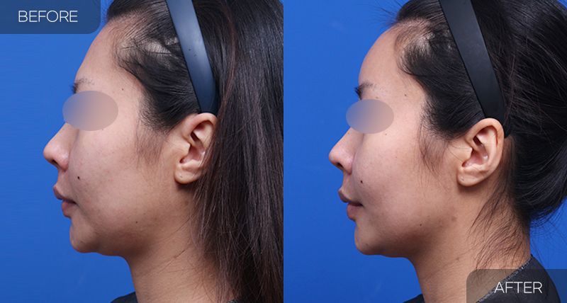 Gambar sebelum dan selepas pembedahan: Pencantuman Lemak Wajah 2 (Pandangan Sisi)