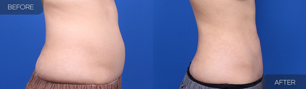 Gambar sebelum dan selepas pembedahan: Sedutan Lemak Abdomen 2 (Pandangan Sisi)