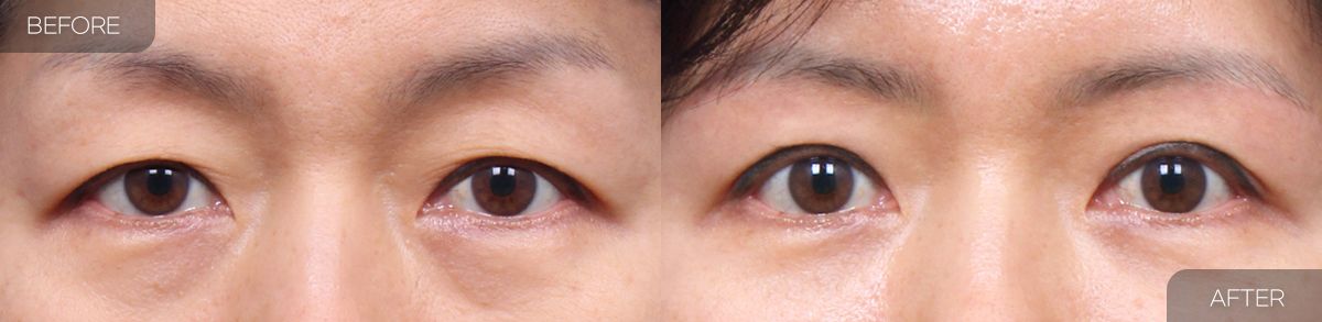 Gambar sebelum dan selepas pembedahan: Pengangkatan Kening 2