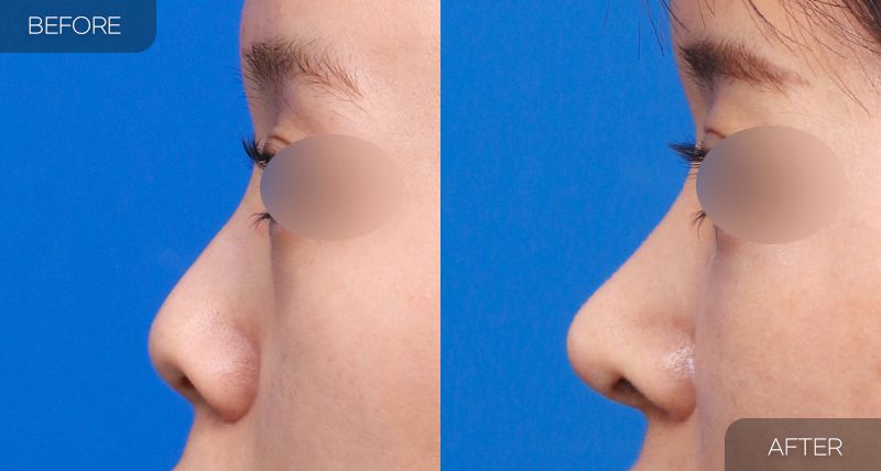 Gambar sebelum dan selepas pembedahan: Hidung Pendek 2