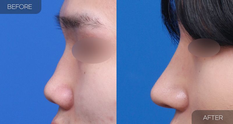 Gambar sebelum dan selepas pembedahan: Hidung Berbonggol 2