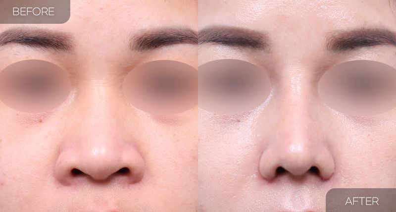 Gambar sebelum dan selepas pembedahan: Hidung Bulbus 2
