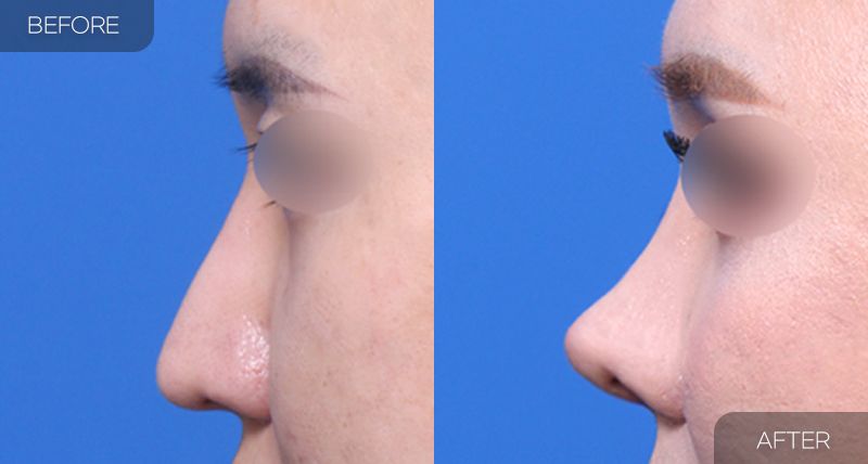Gambar sebelum dan selepas pembedahan: Pembedahan Semula Hidung 2