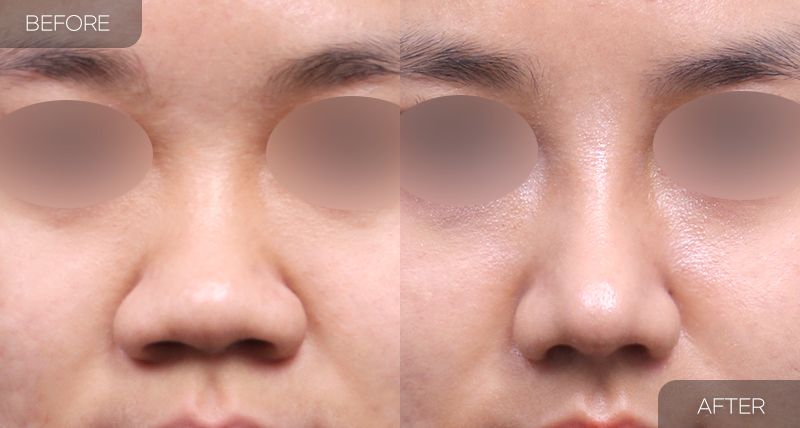 Gambar sebelum dan selepas pembedahan: Pengecilan Cuping Hidung 2