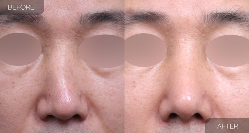 Gambar sebelum dan selepas pembedahan: Hidung Bengkok 2