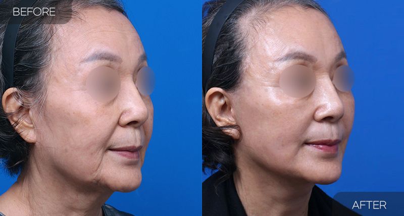 Gambar sebelum dan selepas pembedahan: Facelift Penuh 3 (Sudut 45 Darjah)