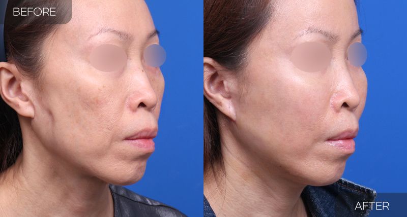 Gambar sebelum dan selepas pembedahan: Mini Facelift 3 (Sudut 45 Darjah)