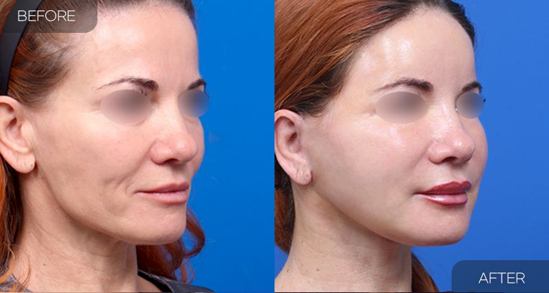 Gambar sebelum dan selepas pembedahan: Facelift Separa 3 (Sudut 45 Darjah)