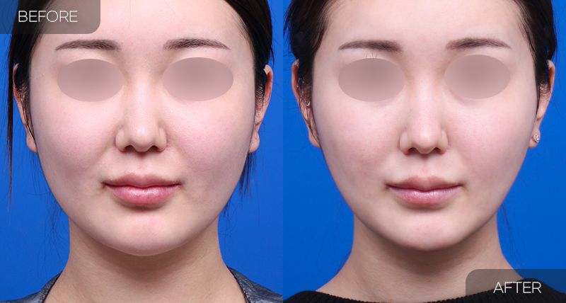 Gambar sebelum dan selepas pembedahan: Thread Lift 3 (Pandangan Hadapan)