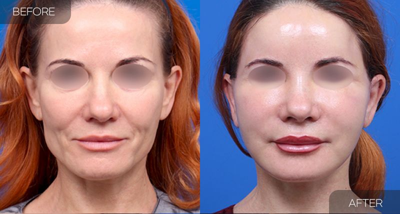 Gambar sebelum dan selepas pembedahan: Facelift Separa 3 (Pandangan Hadapan)