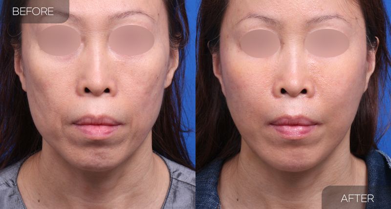 Gambar sebelum dan selepas pembedahan: Mini Facelift 3 (Pandangan Hadapan)