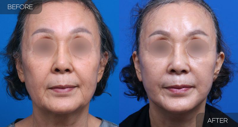 Gambar sebelum dan selepas pembedahan: Facelift Penuh 3 (Pandangan Hadapan)