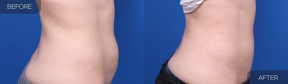 Gambar sebelum dan selepas pembedahan: Sedutan Lemak Abdomen 3 (Pandangan Sisi)