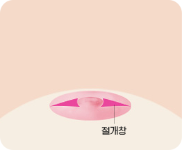 三角皮弁法 01