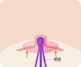 三角皮弁法 02