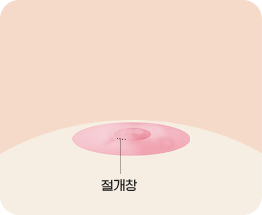 巾着縫合法 01