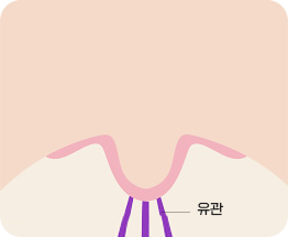 巾着縫合法 02