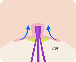 巾着縫合法 03