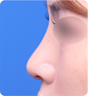 低鼻梁整形 수술 후