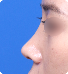 短鼻整形 수술 후
