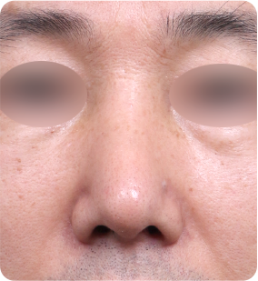 歪鼻整形 수술 후