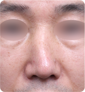 歪鼻整形 수술 전